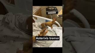 Asterixis flapping hand tremor asterixflappingtremoricucardiologistashortvideohandtremor [upl. by Reltuc]