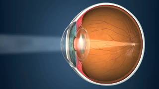 Revitalvision after Cataract Surgery [upl. by Badr]