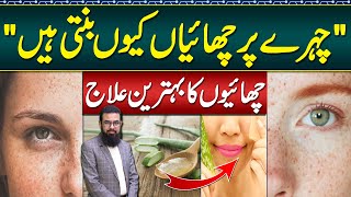 Melasma Treatment at Home  Melasma Cream and Melasma Home Remedies  Face Par Chaiyan Ka Ilaj [upl. by Enenej]