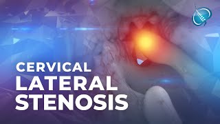 What is Cervical Lateral Stenosis  Foraminal Stenosis [upl. by Devine]