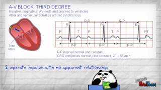 3rd Degree Heart Block [upl. by Acinahs459]