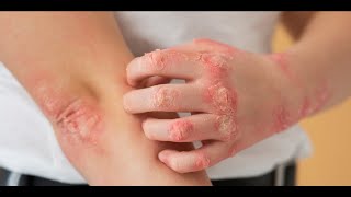 A Clinical Approach to Ayurvedic Management of Childhood Psoriasis [upl. by Aidnama]