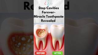 Best toothpaste for tooth cavityBest toothpaste to stop CavitiesFlouride containing Toothpaste [upl. by Lauzon]