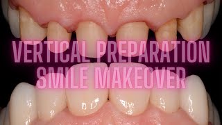 VERTICAL PREPARATION full case Zirconia crowns [upl. by Hgielsel]