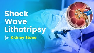 Kidney Stone treatment without Surgery with ESWL or Lithotripsy [upl. by Alikahs]