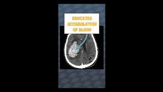 How Intracerebral Haemorrhage Looks on CT Head A Medical Students Guidescience anatomy [upl. by Akinaj341]