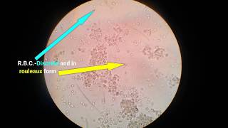 Stool analysisLab diagnosis of dysentery bacillary dysentery [upl. by Brand660]