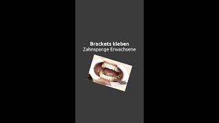 Zahnspange Erwachsene  Brackets kleben shorts [upl. by Korrie792]