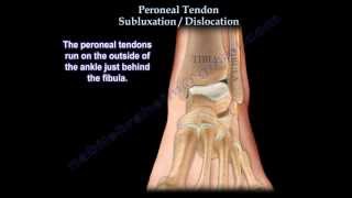 Peroneal Tendon Subluxation  Dislocation  Everything You Need To Know  Dr Nabil Ebraheim [upl. by Liscomb]