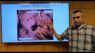 Fallot Tetralogy Part 1 En  Hatem Hosny [upl. by Nalrah]