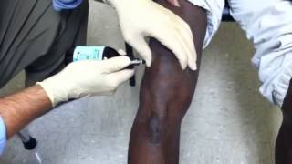 Steroid Knee Injection  Dr George Sutherland Bluffton SC [upl. by Chlo]