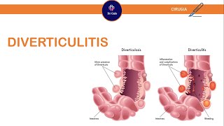 Diverticulitis ParaelENARM [upl. by Eendys]