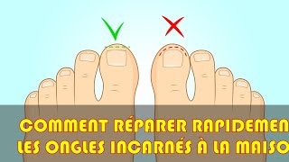 Comment réparer rapidement les ongles incarnés à la maison [upl. by Luttrell817]