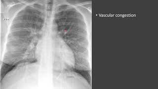 Pulmonary Edema [upl. by Griswold]