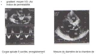 CARDIOLOGIE RÉTRÉCISSEMENT AORTIQUE [upl. by Enihpesoj572]