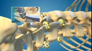 XLIF  DLIF Minimally Invasive Spine Surgery for Back Pain Animation  Dr Neel Anand [upl. by Abekam]