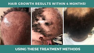 Mesotherapy for Hair Loss Before amp After Results  Platelet Rich Plasma for Hair Loss [upl. by Kirsch]