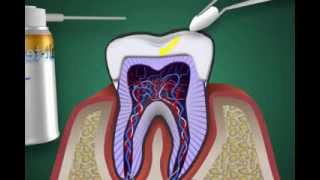 was ist eine Zahnnerventzündung  Pulpitis [upl. by Akcemat]