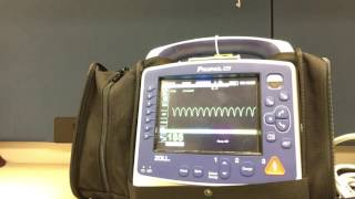 Synchronized Cardioversion with Propaq MD [upl. by Lyall]