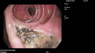 Anastomotic Ulcer виразка гастроентероанастомозу [upl. by Nive]