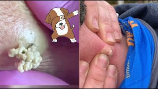 Satisfying Pimple Popping Extractions Watch the Ultimate Dermatology Delight [upl. by Sirrap]