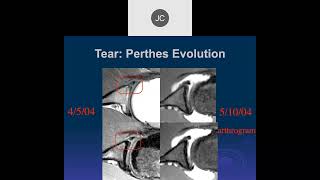 MRI of the Shoulder 2023 – Anterior Labral Tears Part 2 [upl. by Aisha]