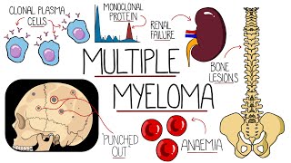 Understanding Multiple Myeloma Multiple Myeloma Explained Clearly [upl. by Airrotal224]