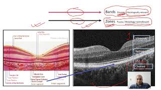 Qualitative analysis of OCT macula OCT interpretation for macular pathologies [upl. by Blader114]