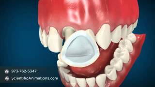 Dental Cap Procedure  Tooth Caps [upl. by Nath]