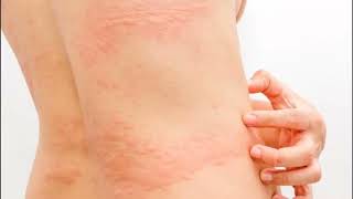 URTICARIA RONCHAS EN EL CUERPO CAUSAS SÍNTOMAS Y TRATAMIENTO [upl. by Kemeny]