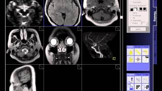 BRAIN MRI NORMAL [upl. by Akinajnat]