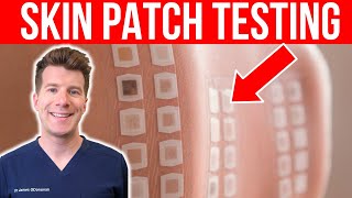 ALLERGY TESTING Doctor explains the Skin Patch Test [upl. by Yllet]