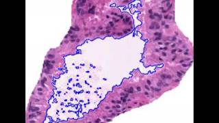 ExpectationMaximization driven Level Set Model for Gland Segmentation on Prostate Histology Images [upl. by Shayne]