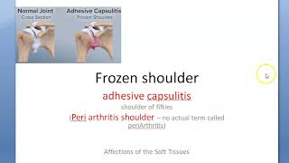 Orthopedics 323 Frozen Shoulder Arthritis adhesive capsulitis shoulder [upl. by Ahseina]