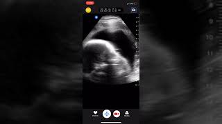 Seven month fetal ultrasound [upl. by Ilwain]