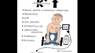 Hyperkalemia [upl. by Randell]