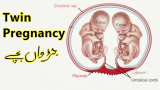 Twin Pregnancy UrduHindi [upl. by Lennahc]