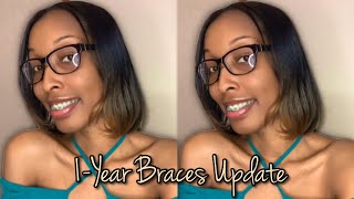 1 Year Braces Update  24hr Wear Elastic Rubber Bands  Powerchain Update  Overall Journey Thus Far [upl. by Banwell]