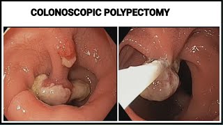 Colonoscopic Polypectomy at SQUARE HOSPITAL LTD Dhaka Bangladesh BDENDOSCOPY [upl. by Halima302]