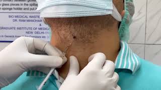 Immunotherapy in warts  Injection MMR for the treatment of warts  Dr Bhawuk Dhir [upl. by Sadnalor]