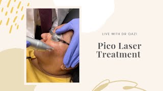 Pico Laser Treatment For Melasma LIVE [upl. by Yboc]