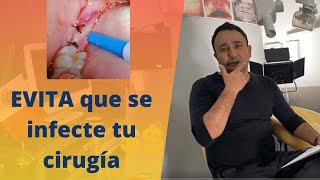 ¿Qué debes haces DESPUES de una CIRUGIA BUCAL [upl. by Oigroeg]