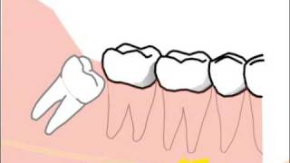alte Version Erklärung spezieller Probleme und Risiken bei der Weisheitszahnentfernung [upl. by Hsuk347]