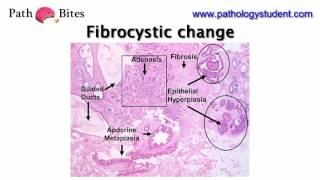 Path Bites  Fibrocystic change [upl. by Donall700]