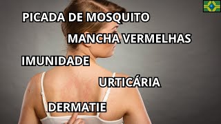 VITAMINA D3  URTICÁRIA  CALCIFEDIOL  DERMATIE  IMUNIDADE  MANCHA VERMELHAS  PICADA DE MOSQUITO [upl. by Hoyt954]