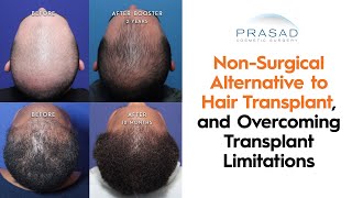 How a NonSurgical Hair Transplant Alternative can Overcome Limitations of Hair Transplants [upl. by Notsuh]