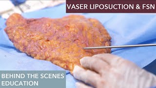 How does Vaser Liposuction work [upl. by Ylrbmik]