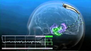 An Implant to Prevent Seizures [upl. by Auburta]