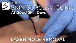 Laser Mole Removal  Watch the Procedure [upl. by Ssirk]