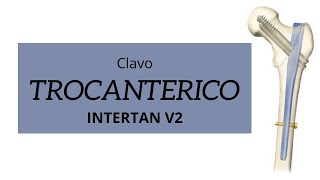 clavo trocanterico Intertan v2 [upl. by Anilatac537]